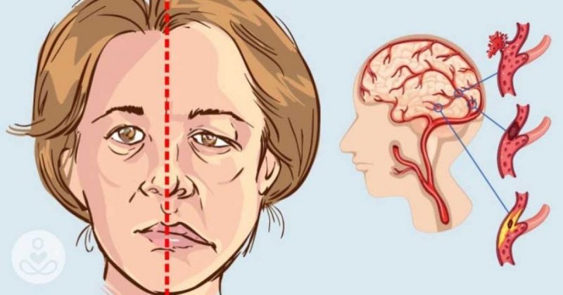 4 etape, pe care ar trebui să le cunoașteți pentru a detecta un accident vascular cerebral