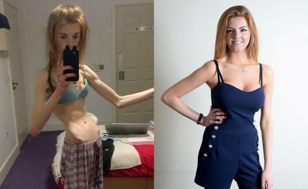 Timp de 5 ani aceasta femeie a mâncat doar o felie de pâine zilnic și a ajuns la 28 de kilograme. Azi atrage toate privirile