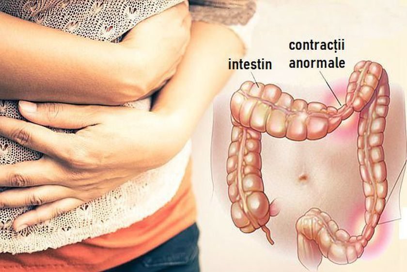 Boala diverticulara a colonului, diverticuloza si diverticulita! O boala ce te poate trimite la Urgenta