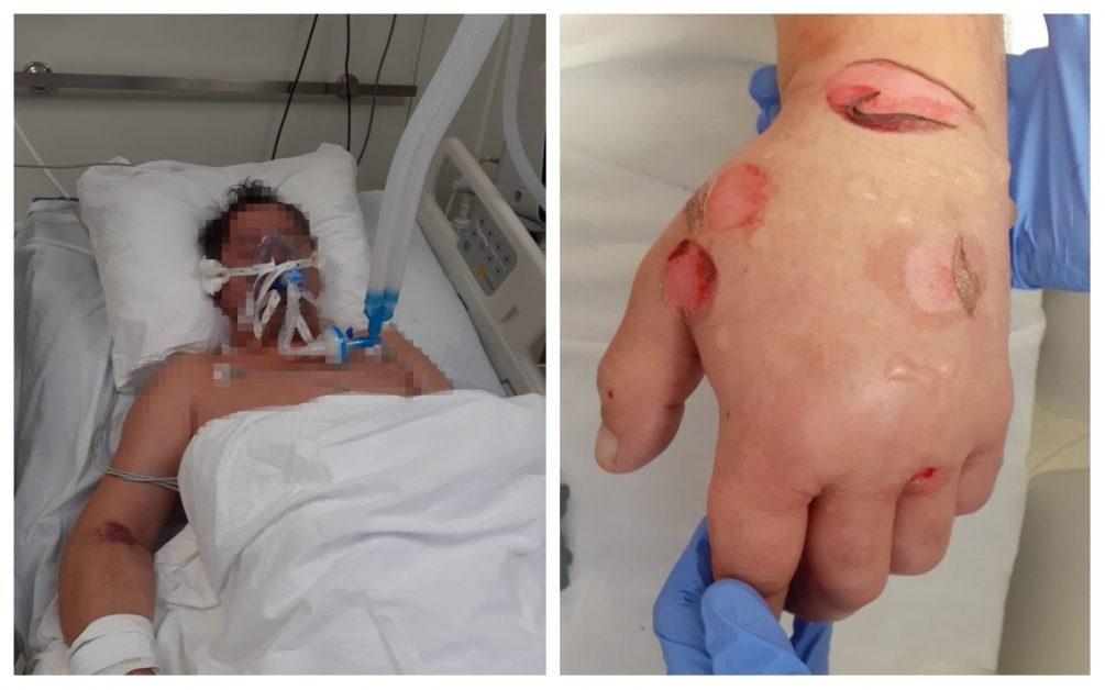 Acuzaţii scandaloase privind morţii de la ATI Sibiu. Medic: ”Ce am văzut eu nu poate fi închipuit de o viață de om. Oamenii nu mor de virus, mor asfixiați, sedați. Abator e puțin spus, ne omorâm între noi”
